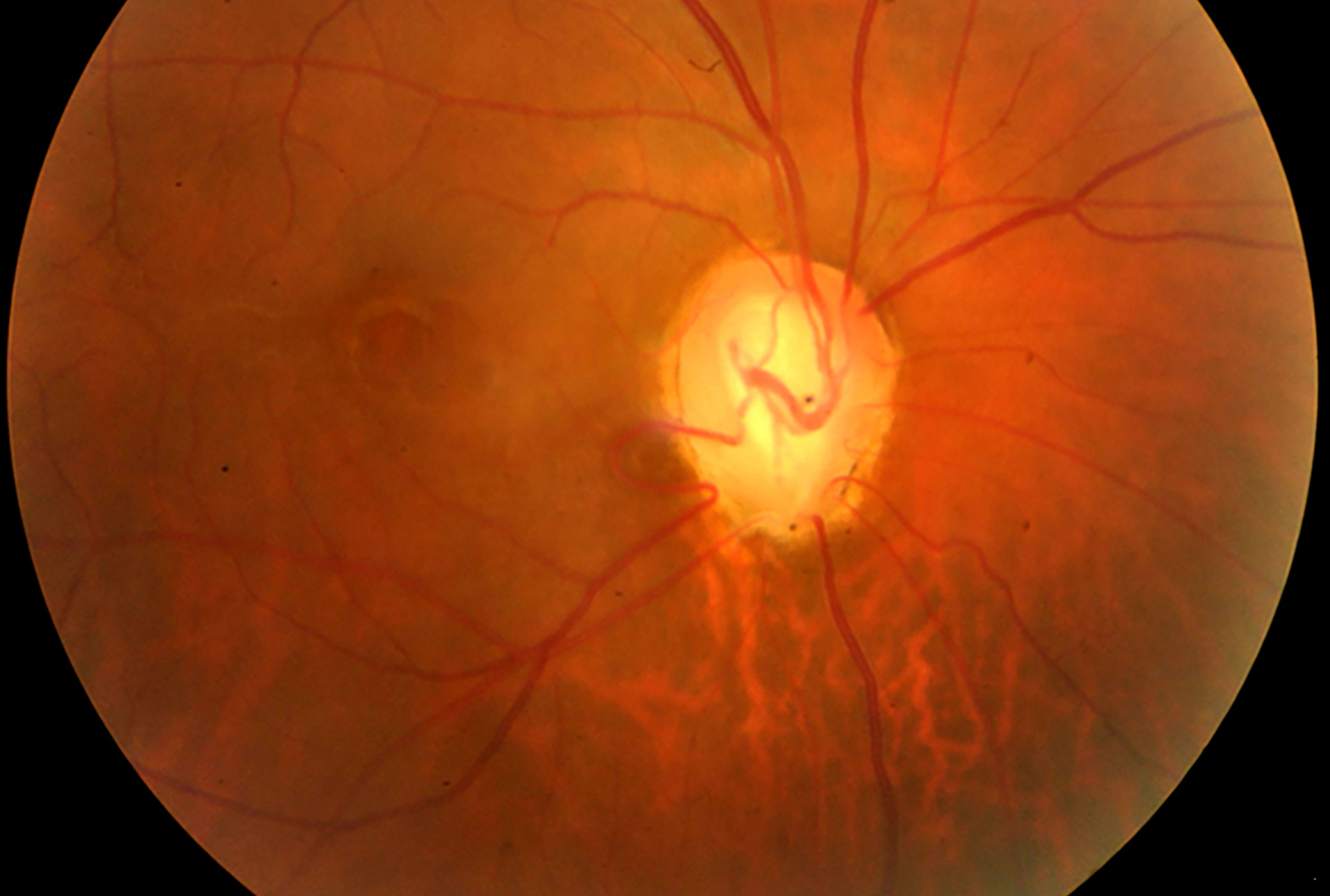 Macular schisis associated with optic disc coloboma