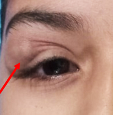 Clinical image showing firm, globular, lobulated right upper eyelid mass (arrow).