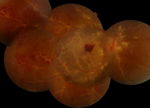 Fundus examination of the right eye revealed a pale, edematous retina, with extensive subretinal fluid in the macula and panretinal florid perivascular sheathing and hemorrhages, with the appearance of frosted branch angiitis.