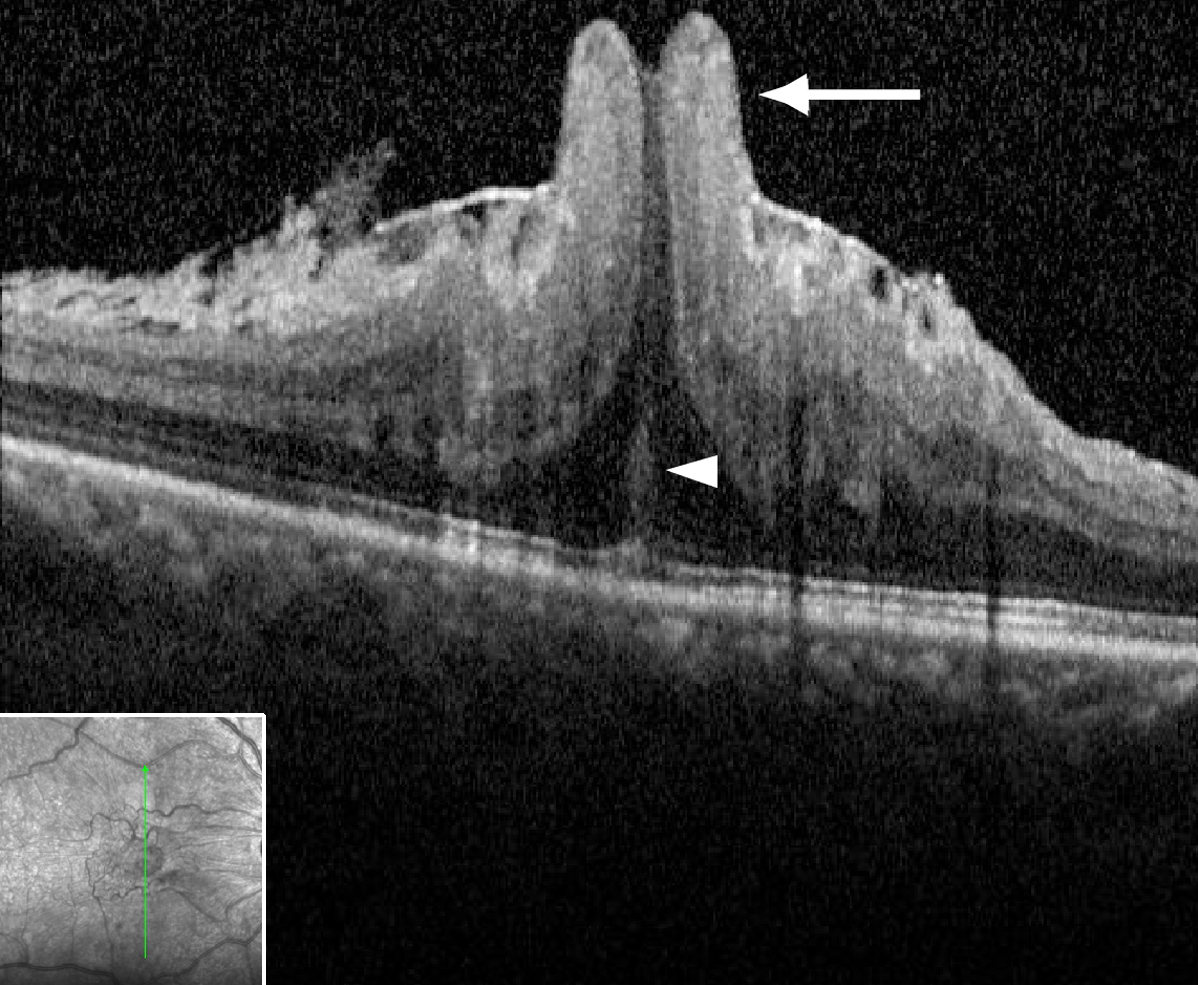 Optical coherence tomography (OCT) revealed that the fovea was protruding through and above the ERM, demonstrating severe foveal herniation (A, arrow).