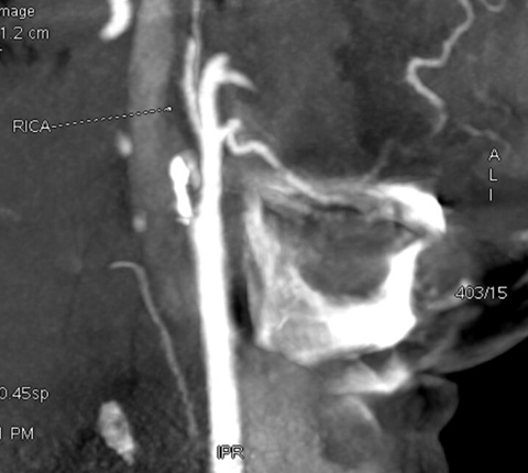 Computed tomography angiogram showing total occlusion of the right internal carotid artery (RICA) in its course in the petrous temporal bone.