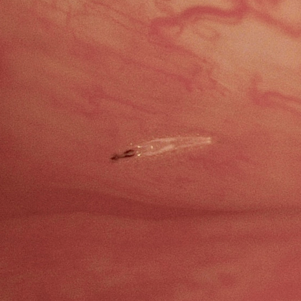 Slit-lamp examination of the right eye revealed 12 larvae of Oestrus ovis, each about 1 mm in length, translucent and with blackish anterior hooks.
