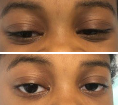 Bilateral ptosis in patient with juvenile ocular myasthenia gravis at presentation (above) and showing improvement in ptosis of >2 mm following administration of ice pack.