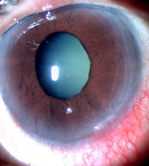 Anterior segment evaluation showed a clear cornea with shallow anterior chamber (Van Herick grade1) and angle closure in all quadrants on gonioscopy.