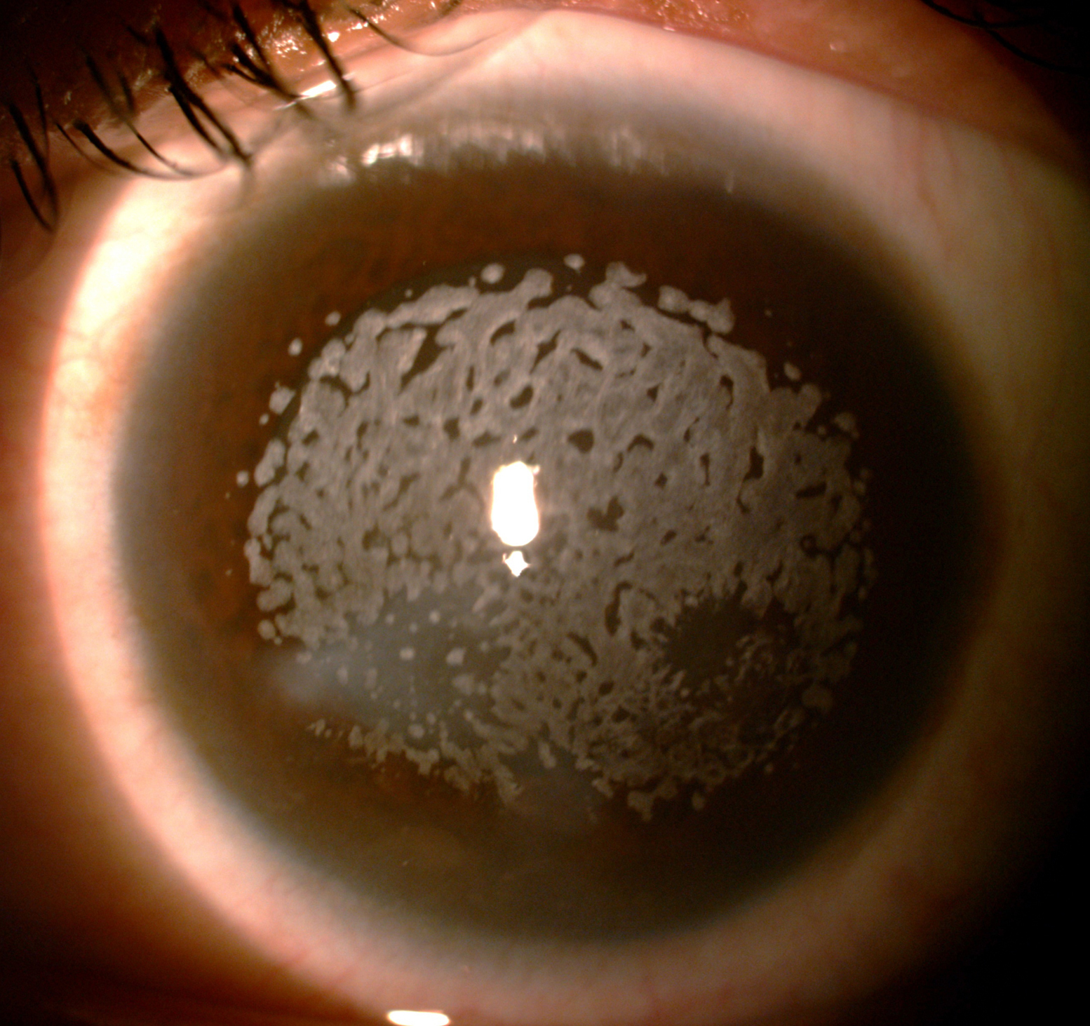 Anterior stromal granular corneal dystrophy.