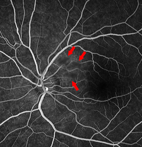 Widefield fluorescein angiography obtained at initial presentation showing small arteriolar filling defects.