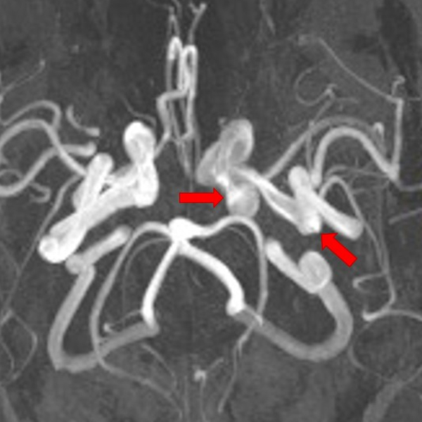 Axial maximum intensity projection magnetic resonance angiography image showing long segment involvement of distal cervical to cavernous portions of the left internal carotid artery, with multiple mycotic pseudoaneurysms and intervening narrowing (arrows).