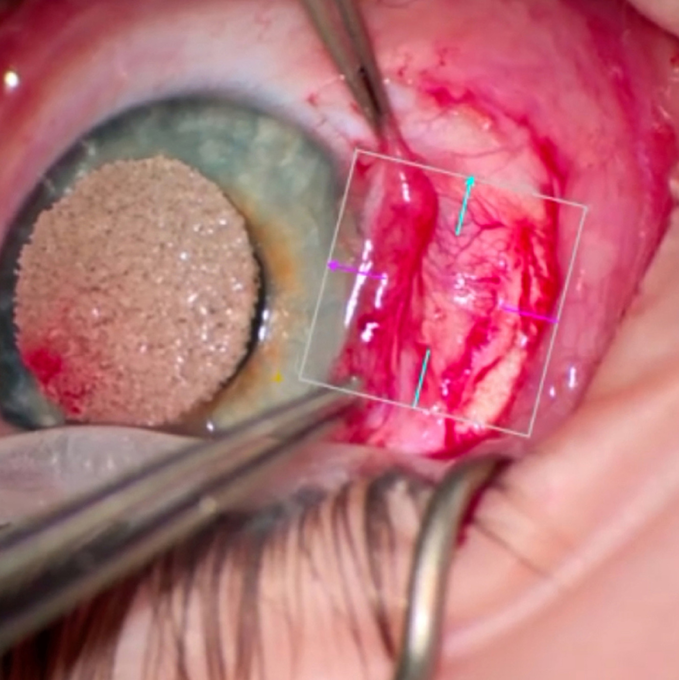 Intraoperative AS-OCT was performed to delineate the cyst wall from the scleral bed.