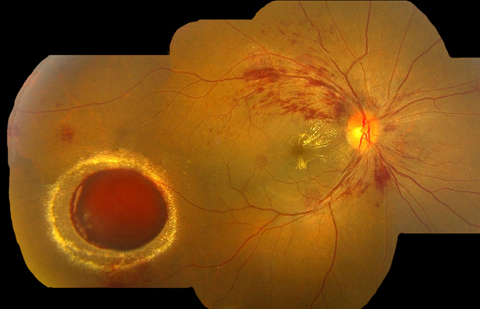 RAM occurs in the bifurcation of retinal arterioles because of thinning and loss of elasticity following chronic hypertension.