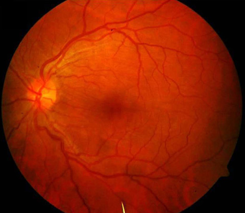 Slit lamp fundus examination revealed multiple curvilinear lines that crossed the macula, superior to the left optic disc.