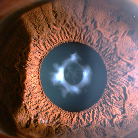 , Healed central capsular defect with opacification of capsular edges and underlying lens cortex.