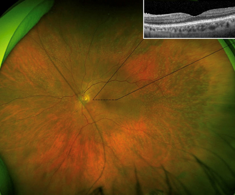 Funduscopic examination showed multiple, midperipheral yellow punctate deposits bilaterally. Optical coherence tomography of the macula revealed an attenuated ellipsoid zone in each eye.