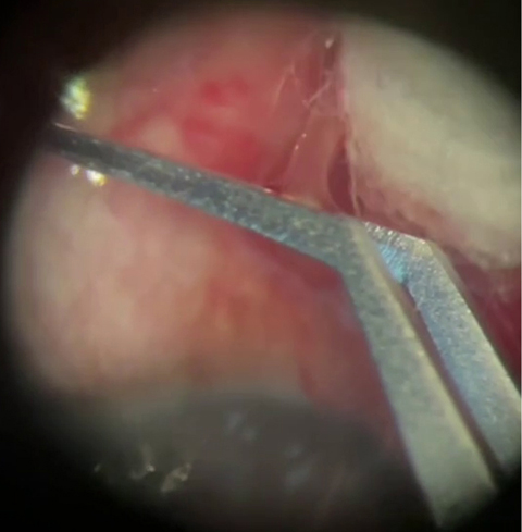 Extraction of subconjunctival Loa loa worm.