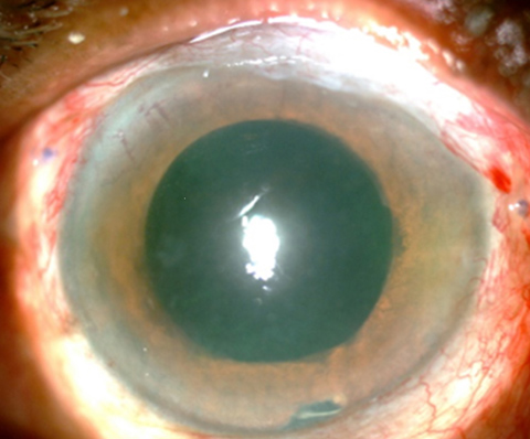 Silicone oil in the anterior chamber.