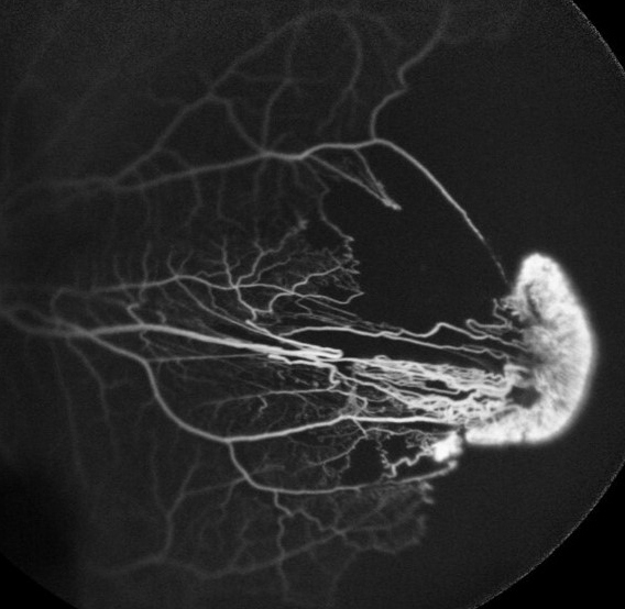 Fluorescein angiography revealed a sea fan-shaped neovascularization with leakage and peripheral capillary nonperfusion areas.