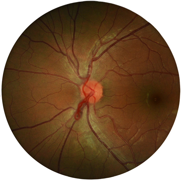 Unilateral congenital prepapillary vascular loop in an 18-year-old man with a complaint of blurred vision.