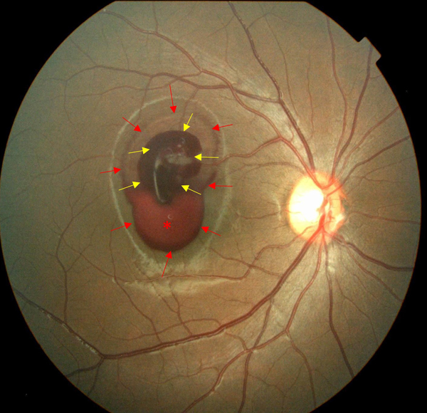 Posterior segment examination revealed hemorrhaging in both the subhyaloidal space and intramacular layers of the affected eye, accompanied by sedimented blood.