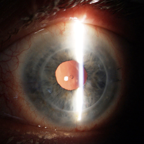 Slit lamp photography depicting the toric ICL stable and well positioned.