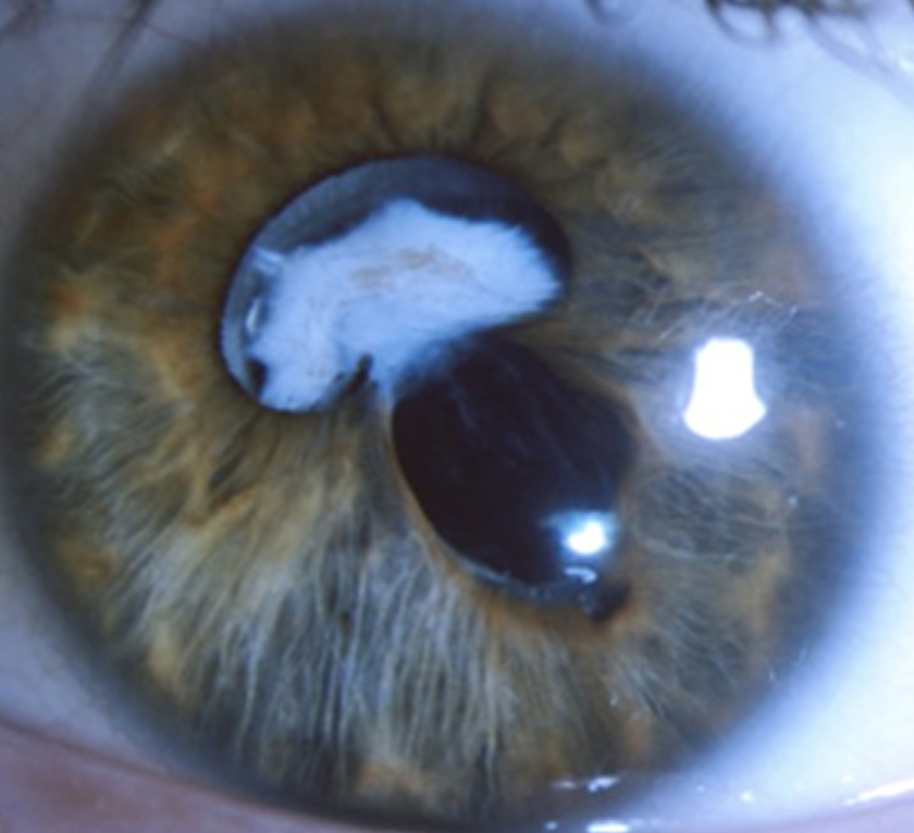 Slit lamp photograph of the left eye at presentation, before dilation.