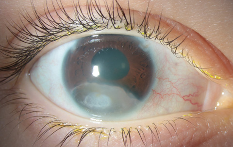 Clinical photograph of right eye showing stromal iris cyst in the inferior quadrant.