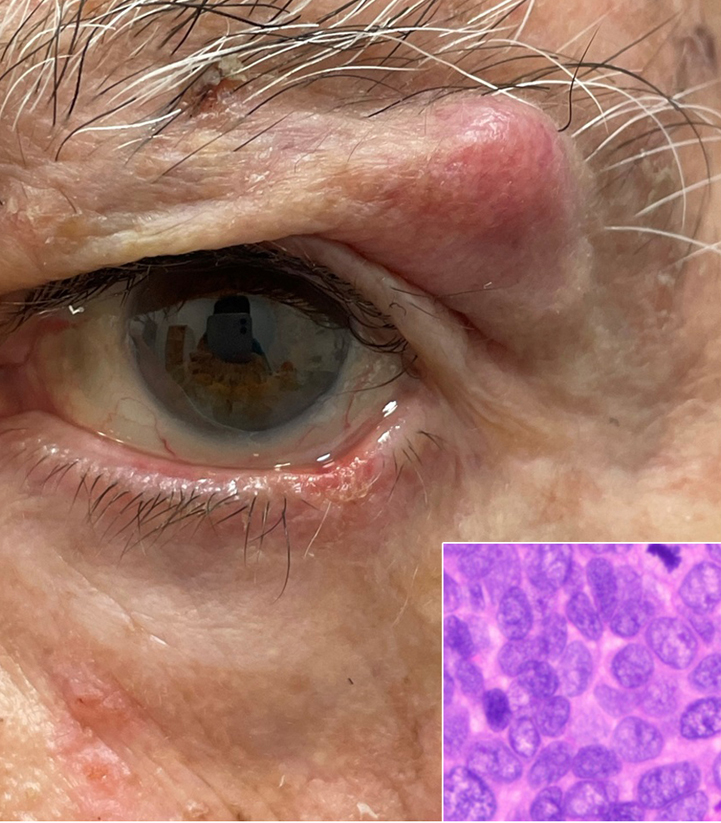 Patient with a nodular, tender-elastic lesion, measuring about 1.9 x 1.2 cm (length x height) and not easily mobile with respect to profound tissues, located just inferiorly to the lateral third of the left brow.