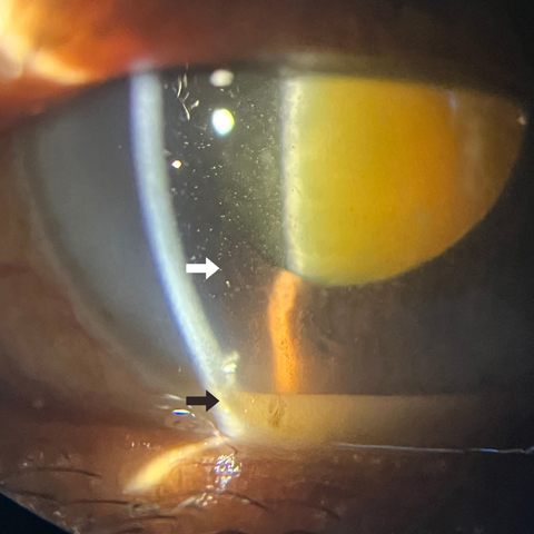 Slit-lamp examination of the left eye revealed minimal conjunctival congestion, clear cornea, and a deep anterior chamber with multiple refractile particles (white arrow) forming a pseudohypopyon (black arrow) and a hypermature (Morgagnian) cataract with an intact anterior lens capsule.