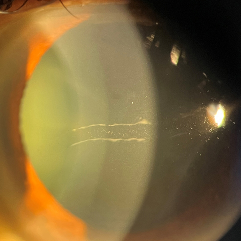 The left eye had two central, horizontally oriented, parallel bands with a few fine vesicles in the intervening endothelial surface of the cornea.