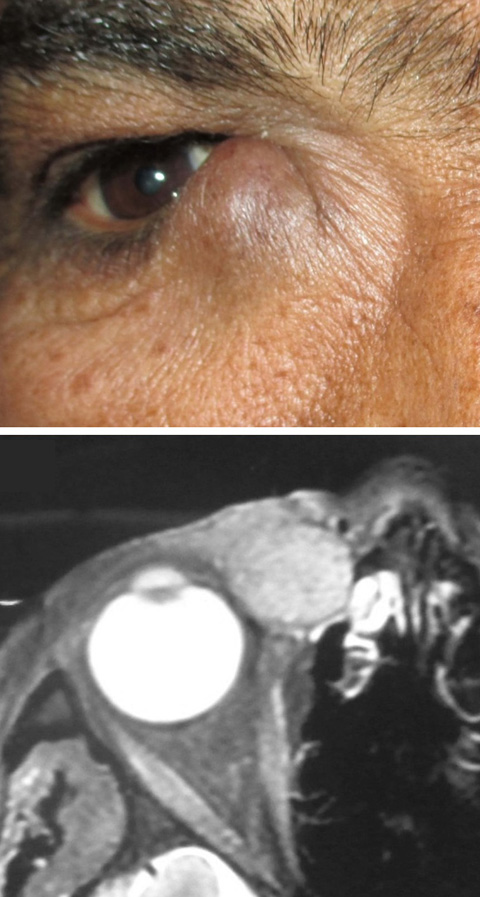 The right lacrimal sac region shows an oval, grape-sized mass extending above the medial canthal tendon, pushing it superiorly. Contrast-enhanced magnetic resonance imaging (axial section) of the orbits shows a well-defined hyperintense mass in the lacrimal sac fossa.