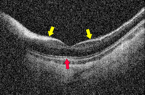 Optical coherence tomography (OCT) of the left eye showing hyperreflective (myelinated) retinal nerve fiber layer (yellow arrows) and preserved ellipsoid zone (red arrow).