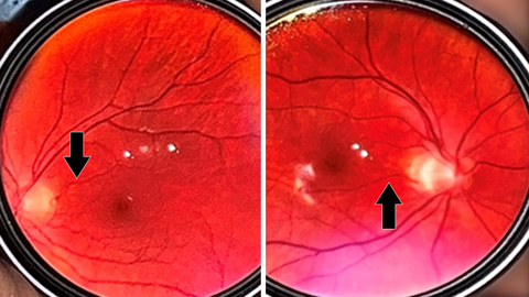 In the right eye, the cilioretinal artery was seen to originate from the upper temporal quadrant, whereas in the left eye, it originated from the lower temporal quadrant.