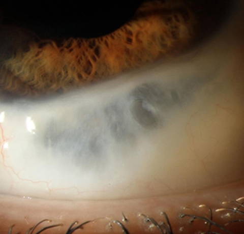 Clinical photograph of patient’s right eye on presentation showing spontaneous filtering bleb spanning 3-4 clock hours inferonasally.