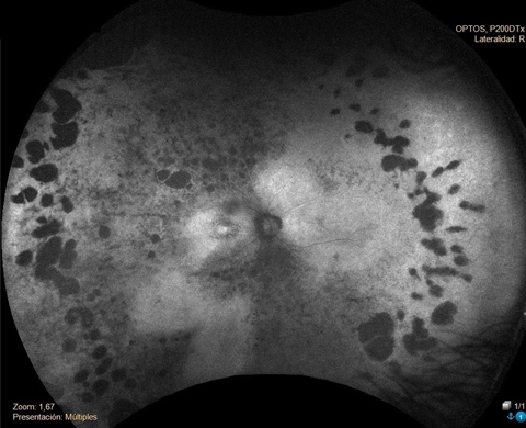 Fundus autofluorescence of patient's right eye.