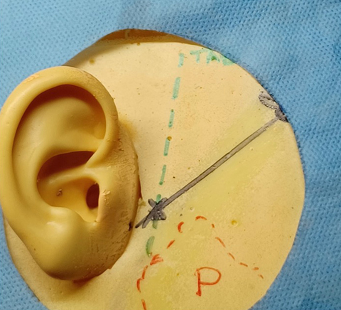 Mapping of the temporal artery and depiction of the danger zone.
