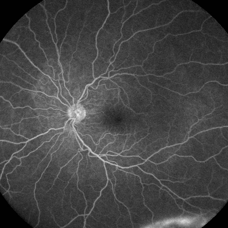 Case 1. Pretreatment wide-field fluorescein angiography (FA) of the left eye showing multifocal punctate hyperfluorescence and dye pooling around the optic nerve and the posterior pole.