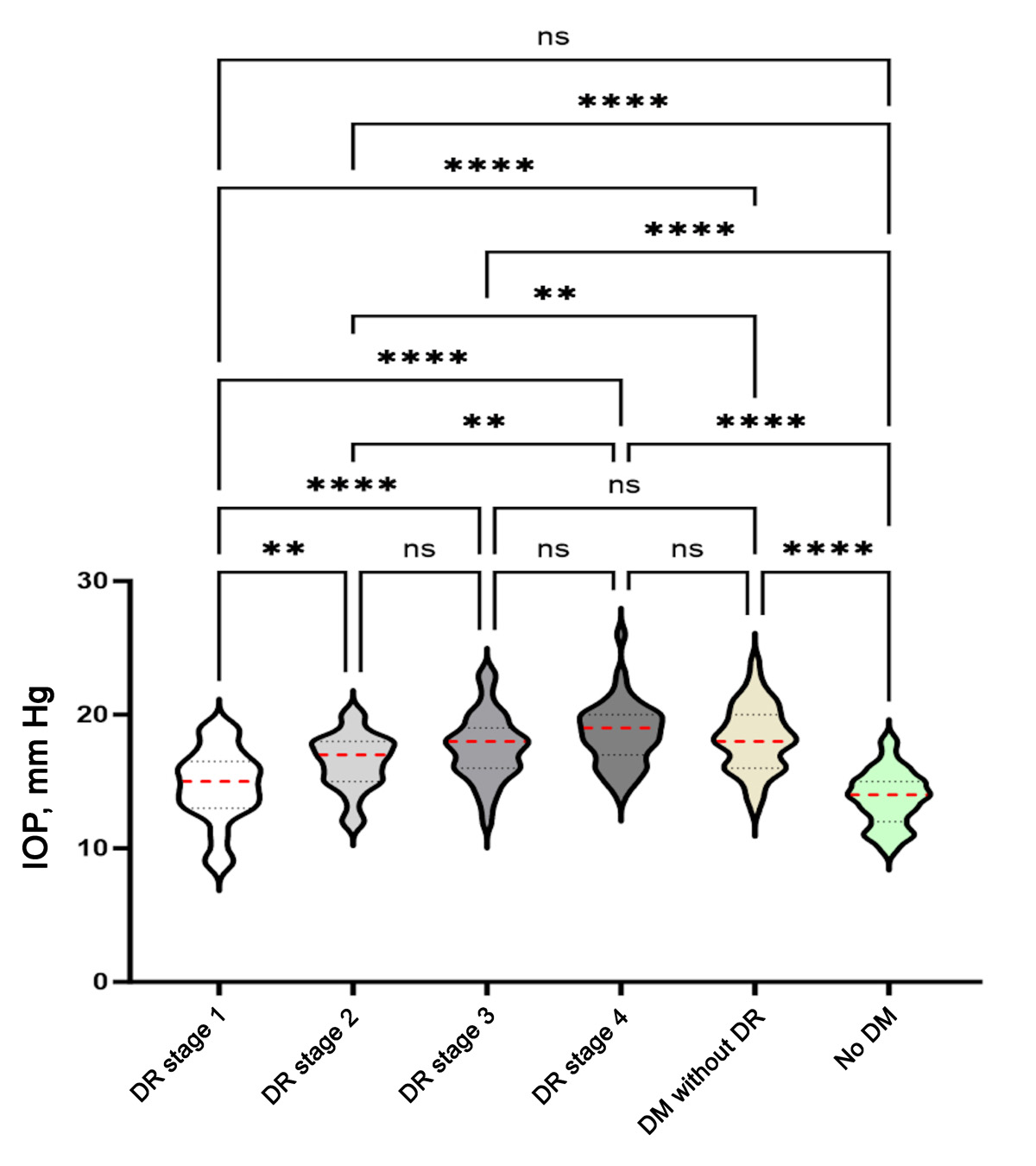 Presence of diabetes mellitus and diabetic retinopathy stages on intraocular pressure readings by sex. The violin plot shows the distribution of IOP data points in each condition. The red dashed line indicates the median; the top and lower black dashed lines, the cutoff for the top 75% and lower 25% of IOP readings.