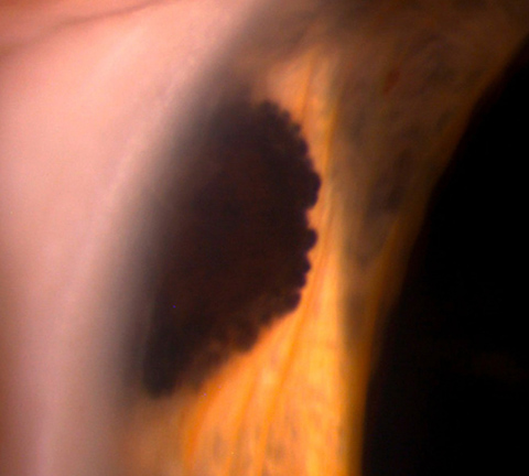 A 68-year-old woman who presented with an asymptomatic melanocytic lesion on the iris of her right eye.